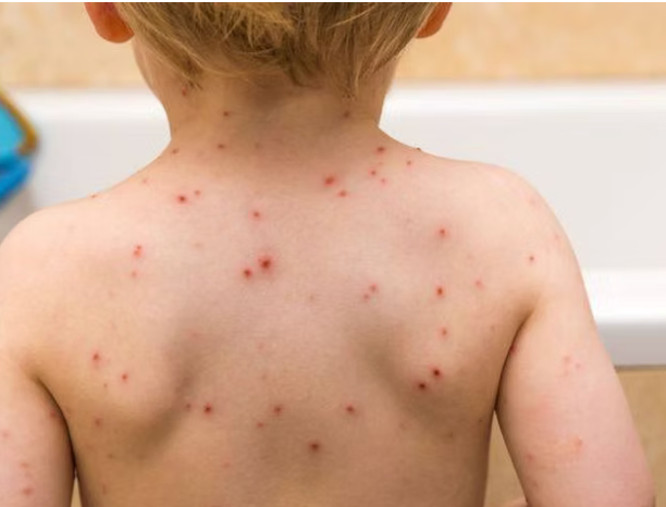 Дархан-Уул, Ховд аймагт менингококкийн халдварын тохиолдол бүртгэгджээ